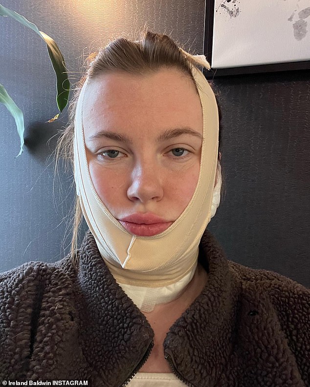 La curación: en un nuevo video de Instagram publicado el martes por la tarde, la modelo de 26 años explicó que FaceTite es un procedimiento en el consultorio mínimamente invasivo de una hora de duración que ni siquiera requiere anestesia.